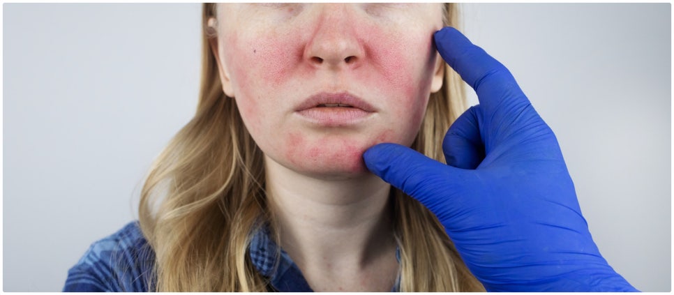 Seocho-gu Vbeam, a Choice for Treating Facial Redness image 2