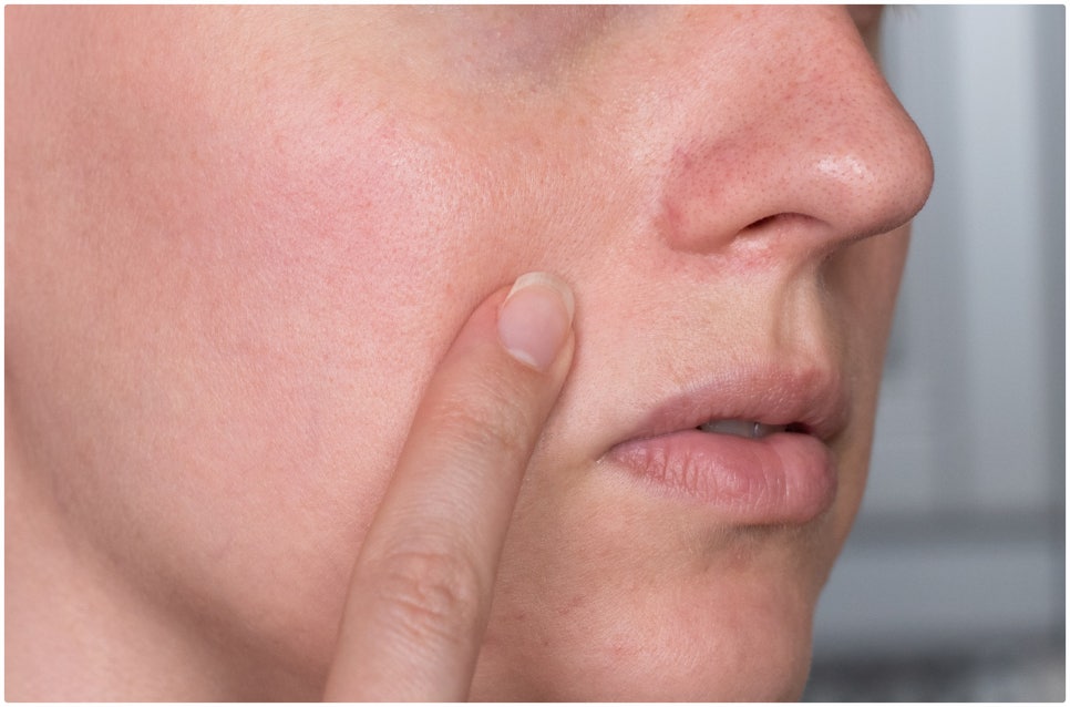 Seocho-gu Vbeam, a Choice for Treating Facial Redness image 4