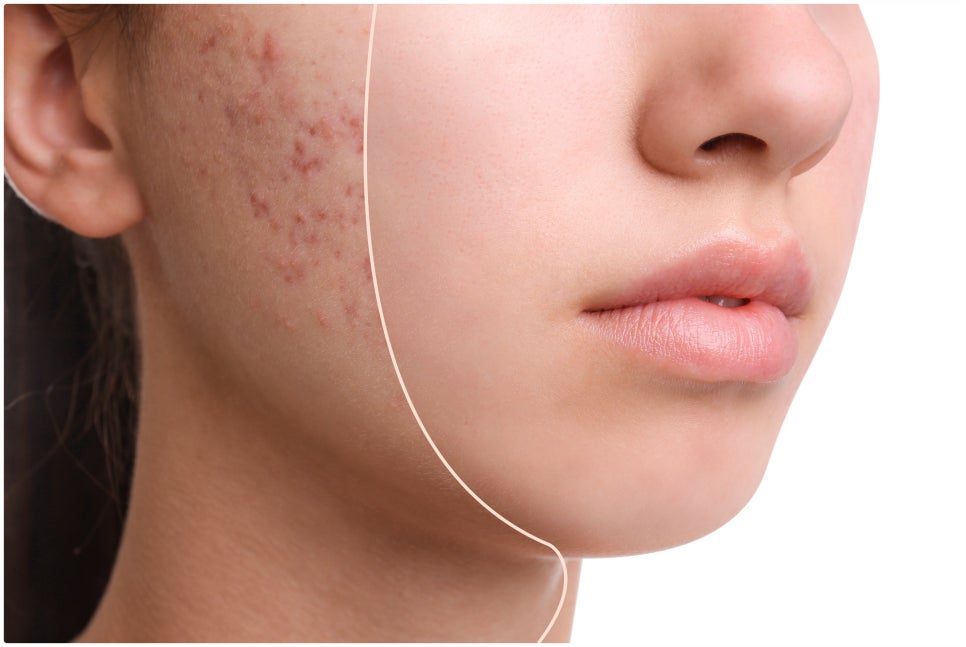 If You’re Stressed by Acne Scars at Sadang Station CUREJET image 1