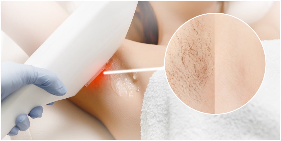 Isu Station Laser Hair Removal for a Neat Impression image 2