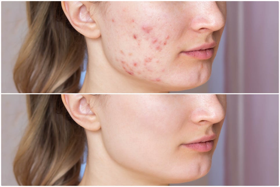 If You’re Stressed by Acne Scars at Sadang Station CUREJET image 7