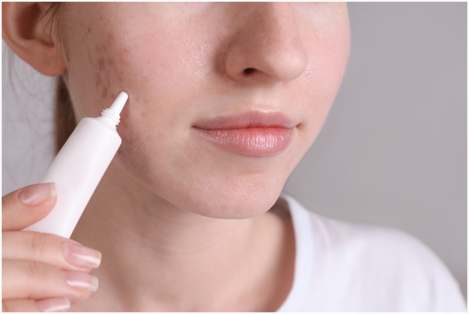 Bangbaeyeok Curet: Reducing the Burden of Pain While Treating Acne Scars image 4