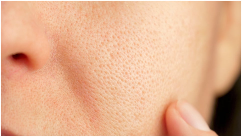 Isu Station Secret Laser for When Pores Are a Concern image 1
