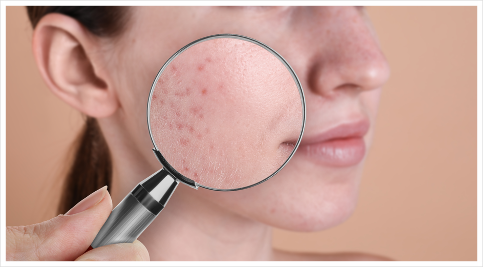 Bangbaeyeok Curet: Reducing the Burden of Pain While Treating Acne Scars image 3