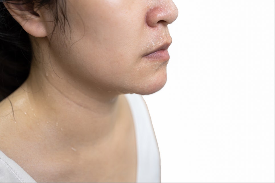 여드름 압출 후 관리 어떻게 하나요? 관련 이미지 4
