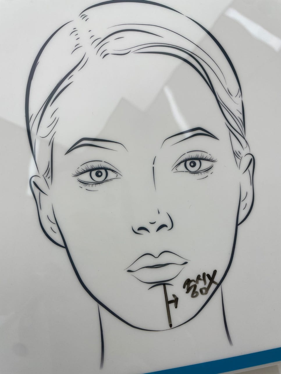 턱필러 주의할 점, 오랫동안 유지하는 방법은? 관련 이미지 4