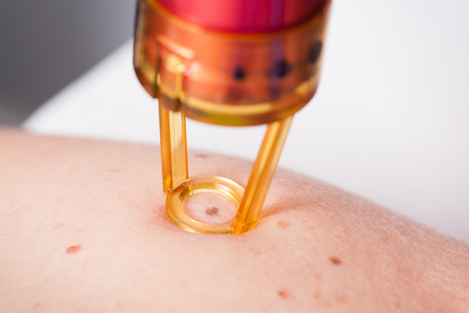 Ishuyeok Melasma Treatment, Essential in Summer image 3