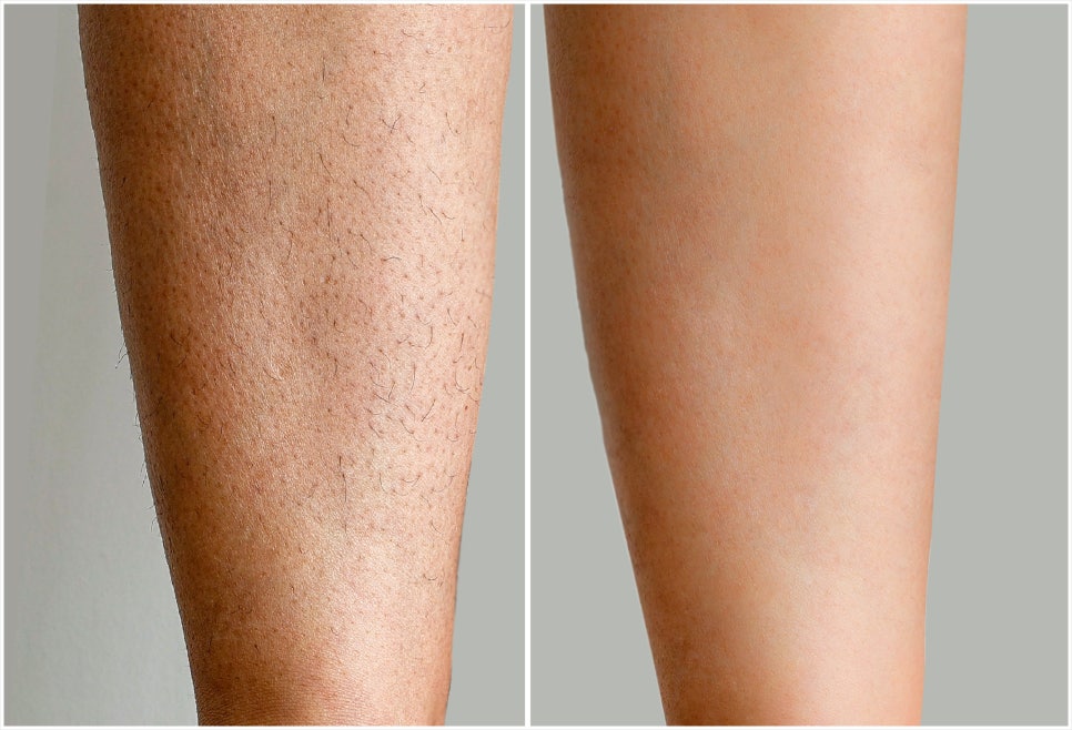 Laser Hair Removal in Seocho-gu: If Dark Stubble Is Bothering You image 1