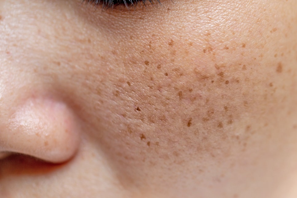 Ishuyeok Melasma Treatment, Essential in Summer image 1