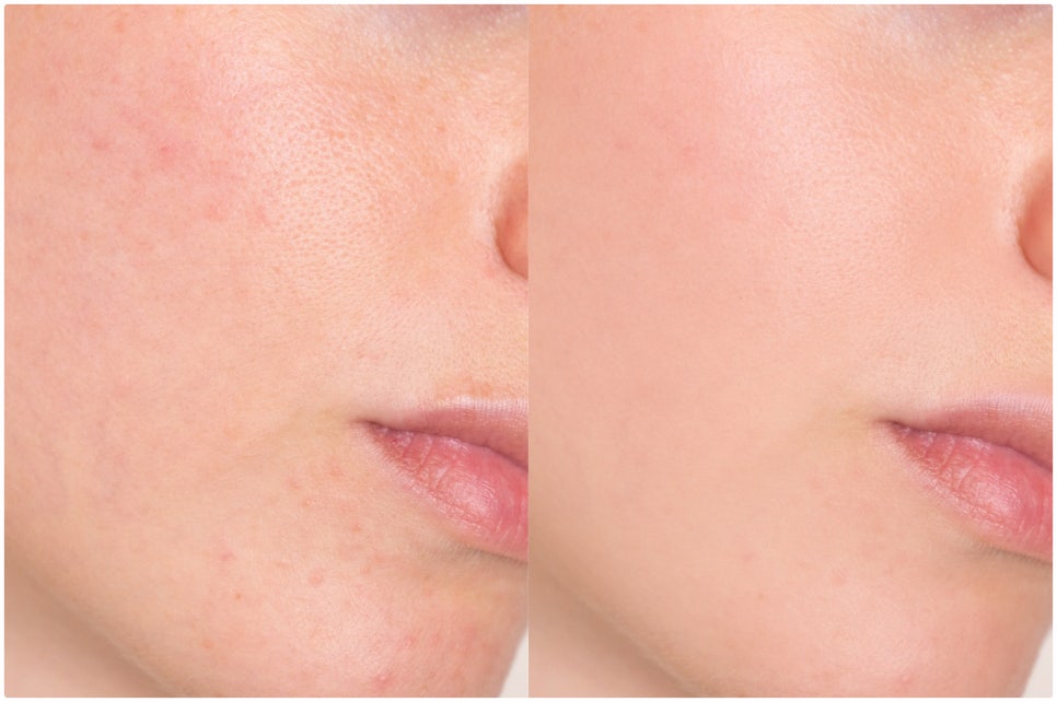 Seocho-gu Vbeam, a Choice for Treating Facial Redness image 1