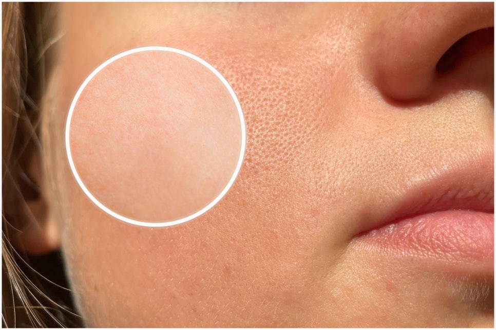 Isu Station Secret Laser for When Pores Are a Concern image 3