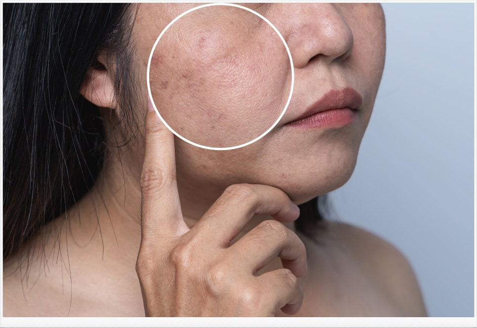 If You’re Worried About Hyperpigmentation in Bangbae-dong Pico Toning image 1