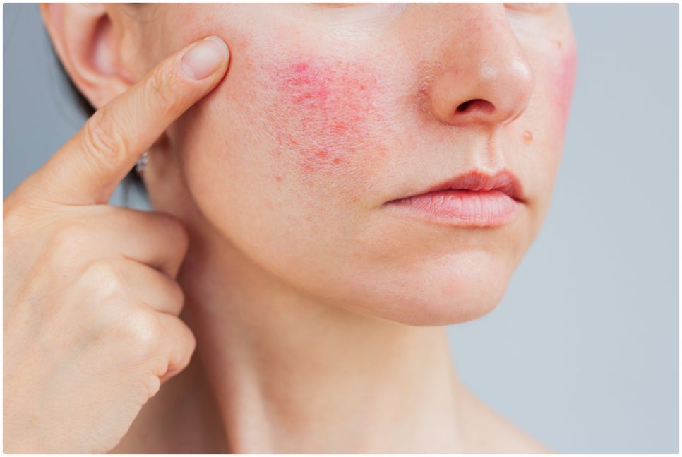Starting with Understanding the Causes of Rosacea in Isu Station Vbeam Perfecta image 3