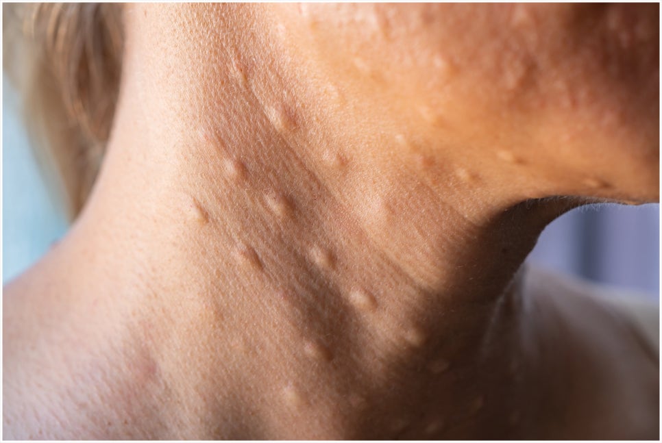 Banpo-dong Painless Rejuran: If You’re Considering the Procedure Because of Pain image 5