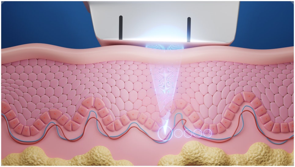 If You’re Looking for a Place That Does Thermage Well in Bangbae-dong image 2