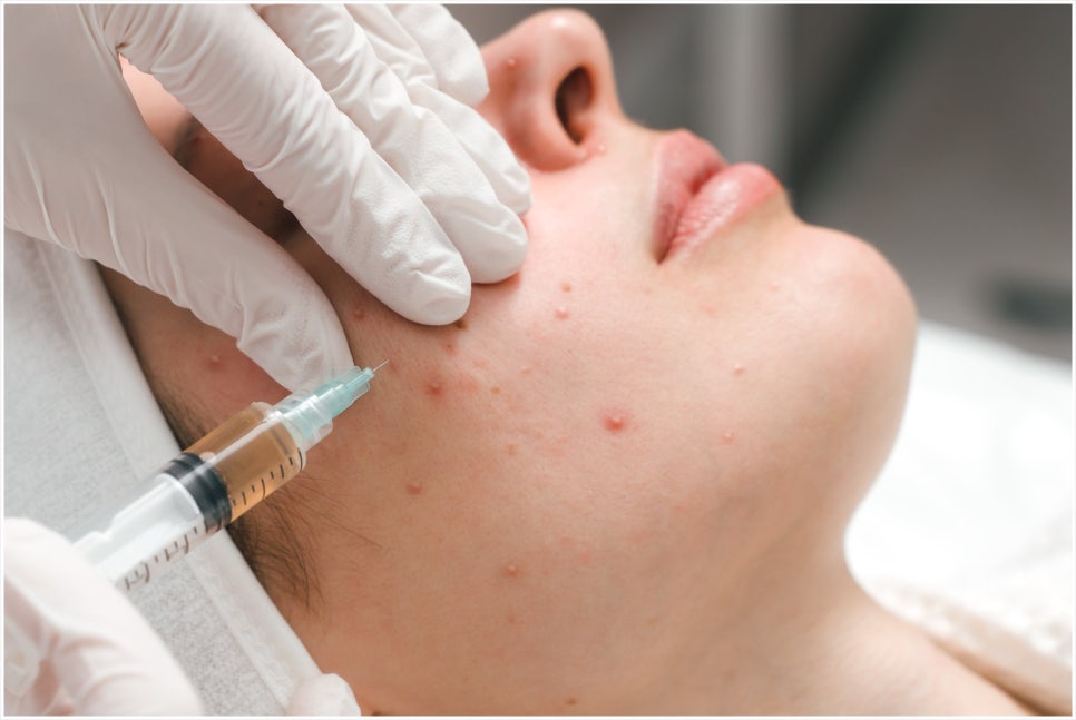 How to Respond Early to Acne Scars in Seocho-gu image 3