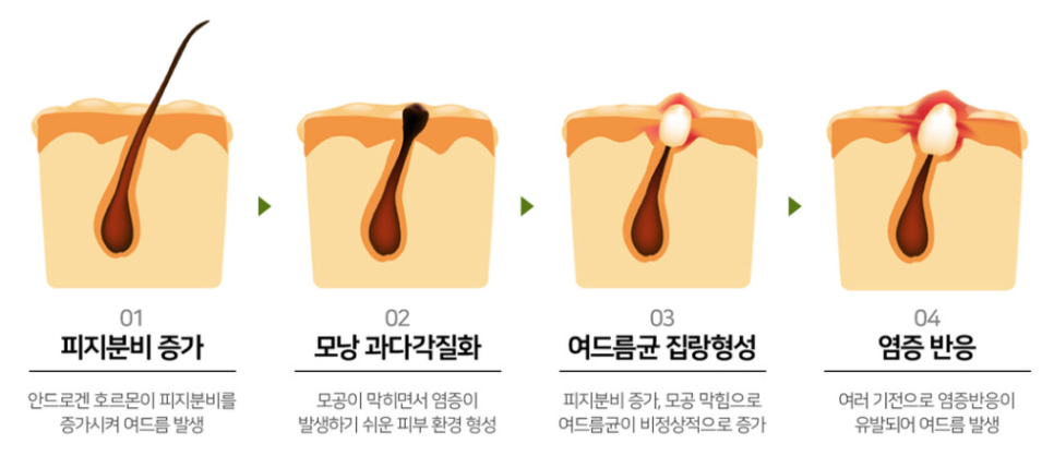 그리니피부과 여드름 치료 사례-1 관련 이미지 3