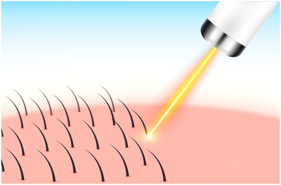 Sadang Station Male Laser Hair Removal with the New GentleMax Pro Plus image 3