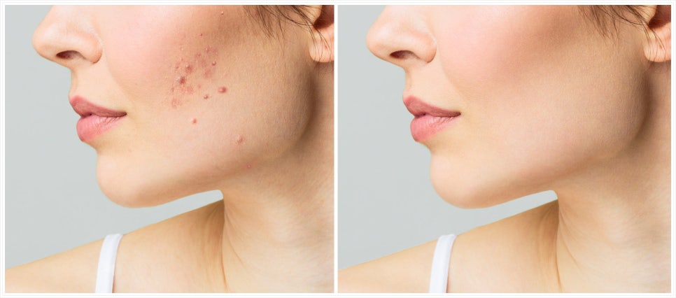 If You Are Feeling Stressed About Acne Treatment in Bangbaedong image 13