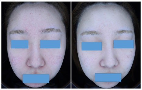 If You Are Feeling Stressed About Acne Treatment in Bangbaedong image 10