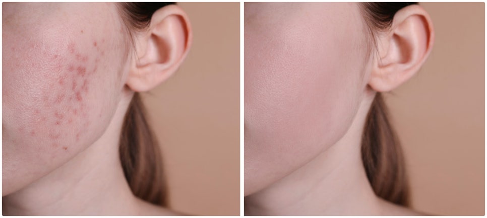 Seocho-gu Acne Treatment with a Method Based on Your Condition image 1