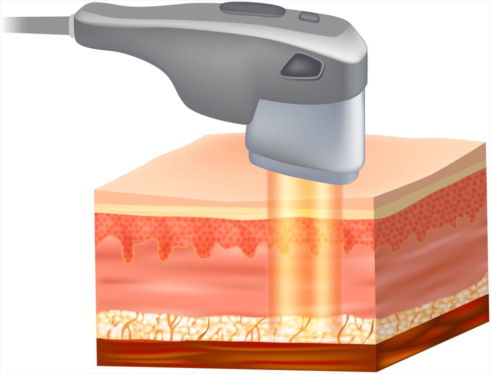 If You’re Considering Ulthera at Bangbae Station Dermatology, Come to Greeni Dermatology! image 2