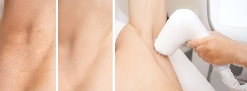 Seocho-gu Sunday Dermatology Clinic: A Neat Impression Through GentleMax Pro Plus Laser Hair Removal image 5