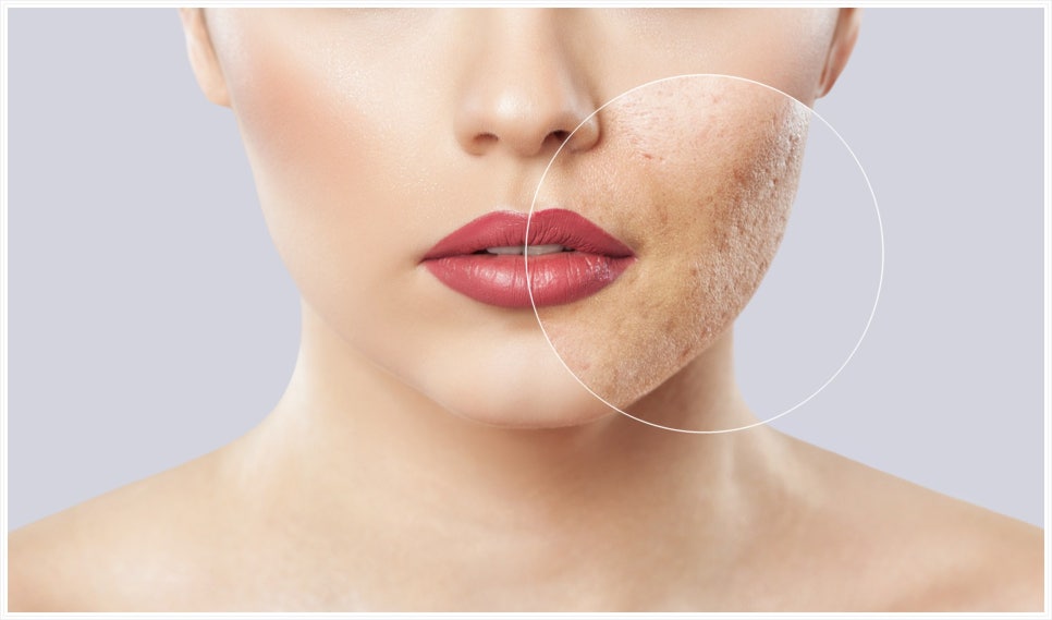 If You Are Feeling Stressed About Acne Treatment in Bangbaedong image 2