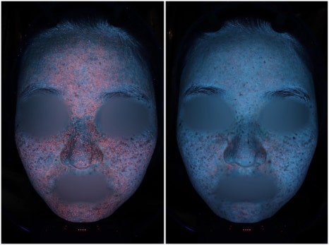 If You Are Feeling Stressed About Acne Treatment in Bangbaedong image 9