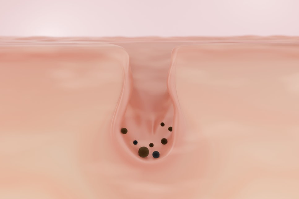 Managing Pores in Summer with Aquapeel Near Bangbae Station image 3