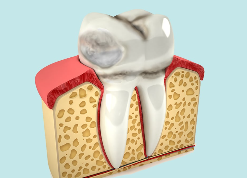 4 Things You Need to Know About Tooth Erosion If You Don’t Want to Get Into Trouble at Sinsa Station Dental Clinic image 2