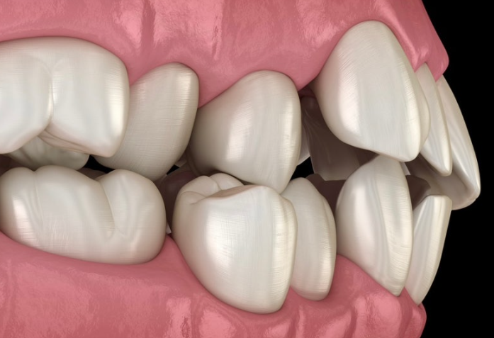 Jamwon-dong Dental Clinic Shinseong Dental: 4 Reasons You Should Not Leave Wisdom Teeth Untreated image 7