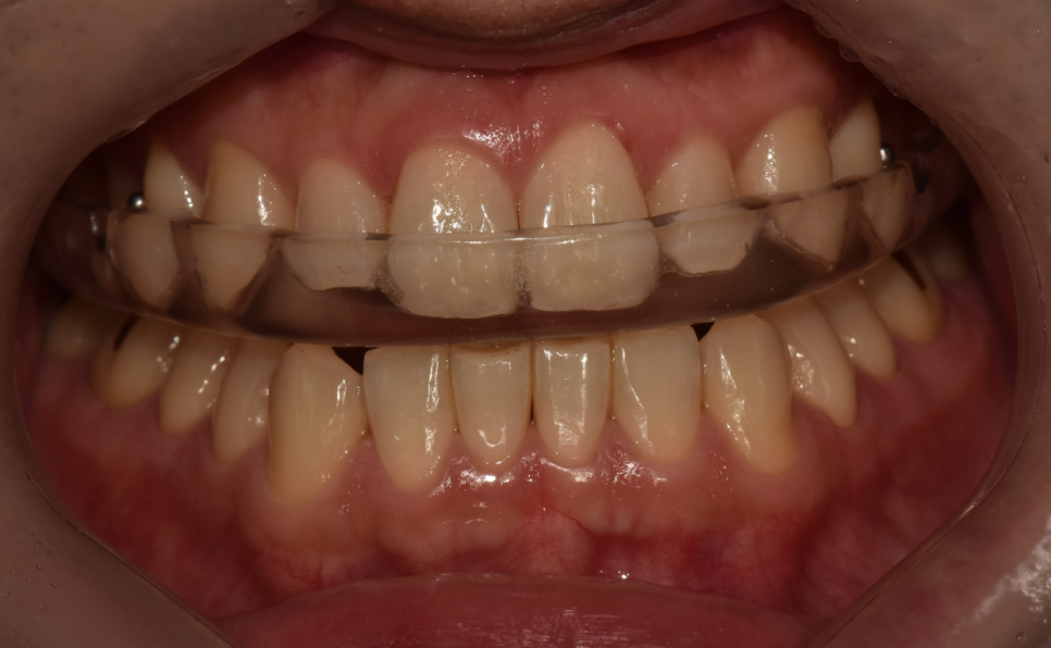 Gangnam Station Dentist) Actual Botox Treatment Case for a Patient with Sleep Bruxism! image 3