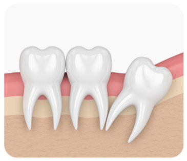 잠원역치과 신성치과 사랑니 발치 전 꼭 알아야 하는 3가지 관련 이미지 6
