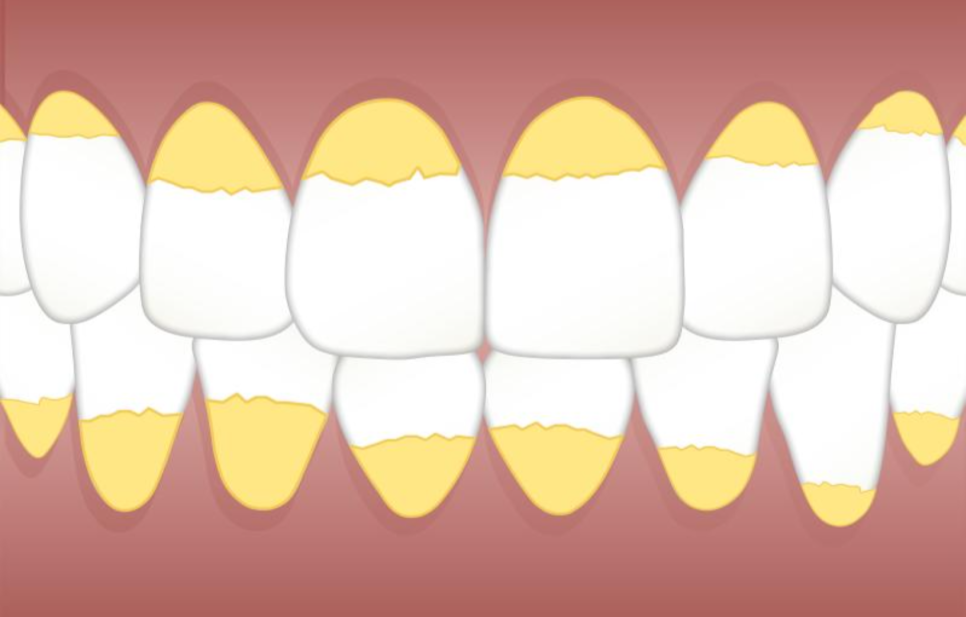 Three Problems That Can Occur If You Don’t Remove Tartar at an Apgujeong Dental Clinic image 2