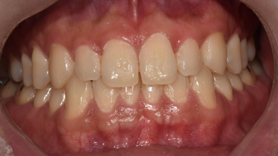 Gangnam Station Dentist) Actual Botox Treatment Case for a Patient with Sleep Bruxism! image 1