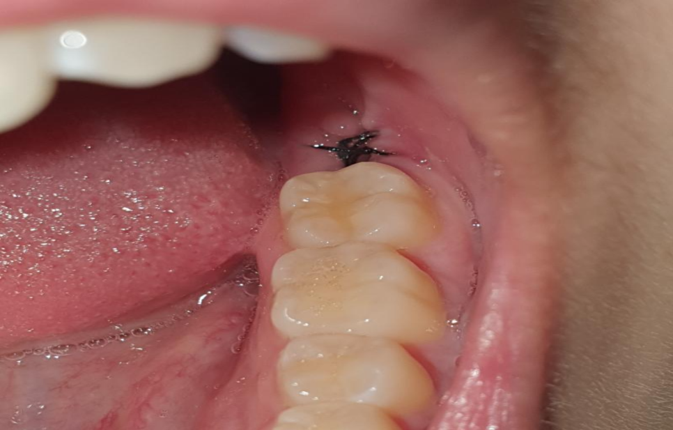 잠원역치과 신성치과 사랑니 발치 전 꼭 알아야 하는 3가지 관련 이미지 12