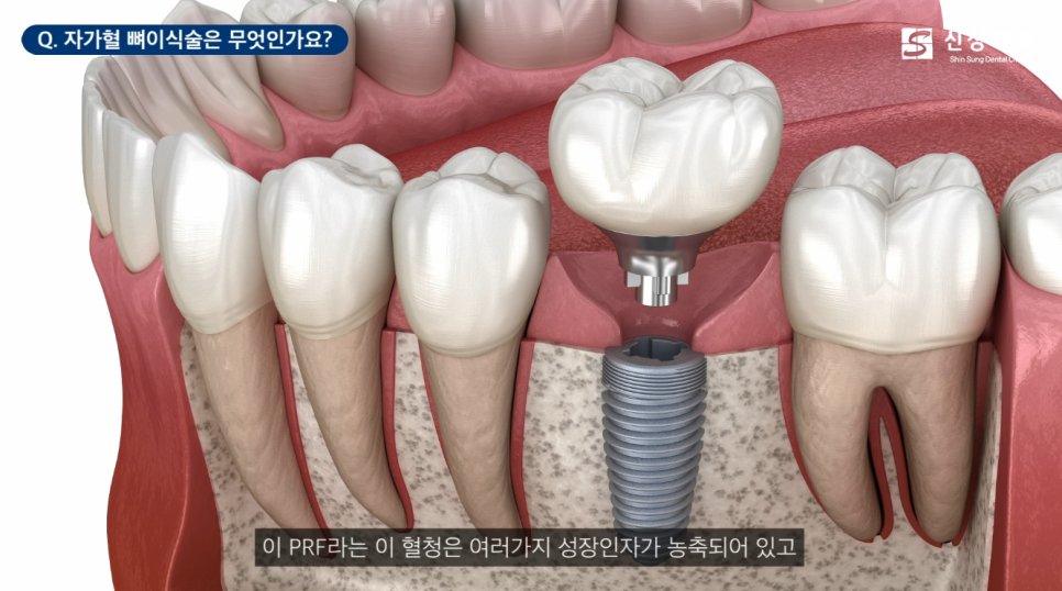 신사역임플란트 잘하는 신성치과 특징 4가지 <필독> 관련 이미지 7