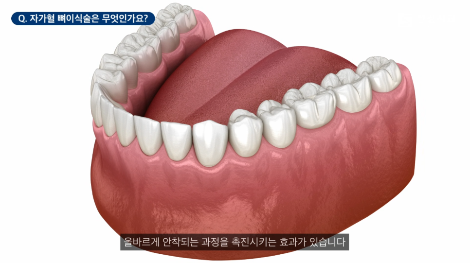 신사역임플란트 잘하는 신성치과 특징 4가지 <필독> 관련 이미지 10
