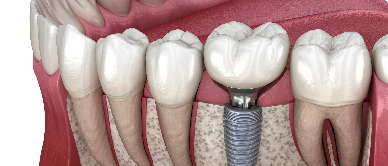 서초구치과 충치 치료 확실히 끝내고 싶다면 이것 보세요 관련 이미지 10