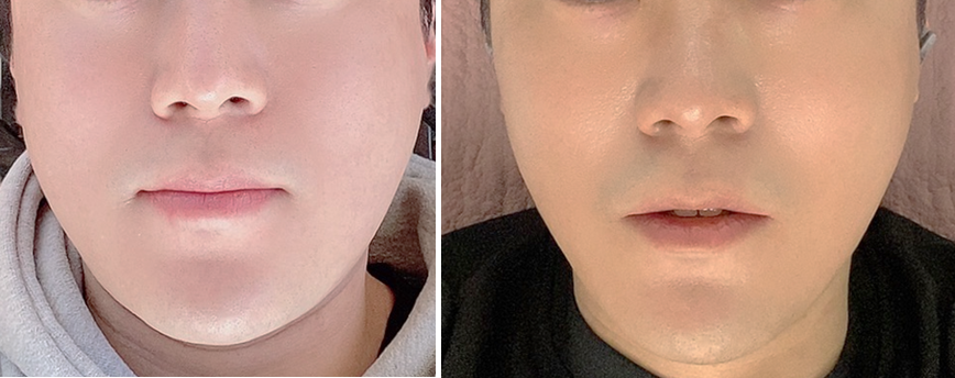 Gangnam Station Dentist) Actual Botox Treatment Case for a Patient with Sleep Bruxism! image 2