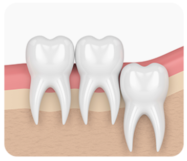 잠원역치과 신성치과 사랑니 발치 전 꼭 알아야 하는 3가지 관련 이미지 7