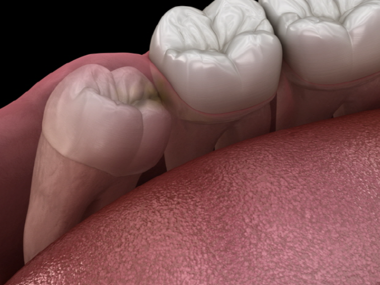 Jamwon-dong Dental Clinic Shinseong Dental: 4 Reasons You Should Not Leave Wisdom Teeth Untreated image 3