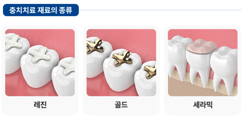 서초구치과 충치 치료 확실히 끝내고 싶다면 이것 보세요 관련 이미지 8