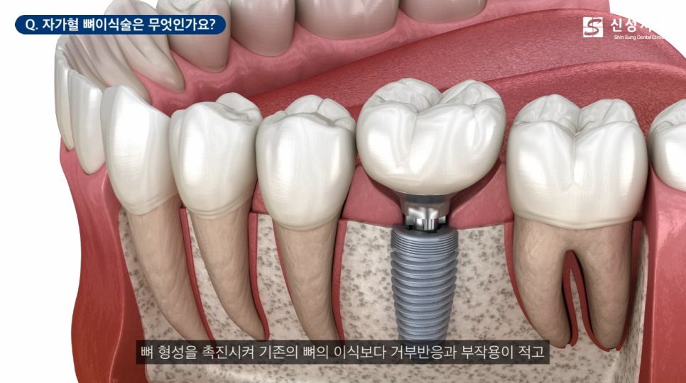 신사역임플란트 잘하는 신성치과 특징 4가지 <필독> 관련 이미지 8
