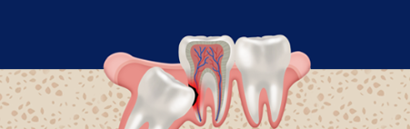 Jamwon-dong Dental Clinic Shinseong Dental: 4 Reasons You Should Not Leave Wisdom Teeth Untreated image 8