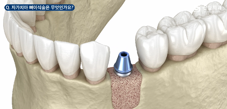 잠원동치과 임플란트 뼈이식 성공을 위한 2가지 방법 관련 이미지 6