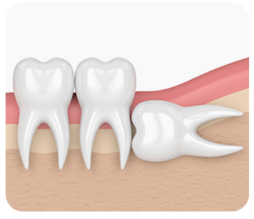 잠원역치과 신성치과 사랑니 발치 전 꼭 알아야 하는 3가지 관련 이미지 8