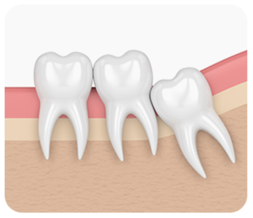 잠원역치과 신성치과 사랑니 발치 전 꼭 알아야 하는 3가지 관련 이미지 5