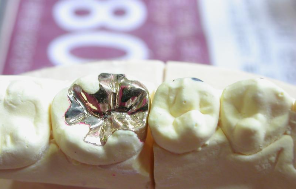 논현역치과 신성치과 충치 치료도 제대로 받아야 합니다. 관련 이미지 8